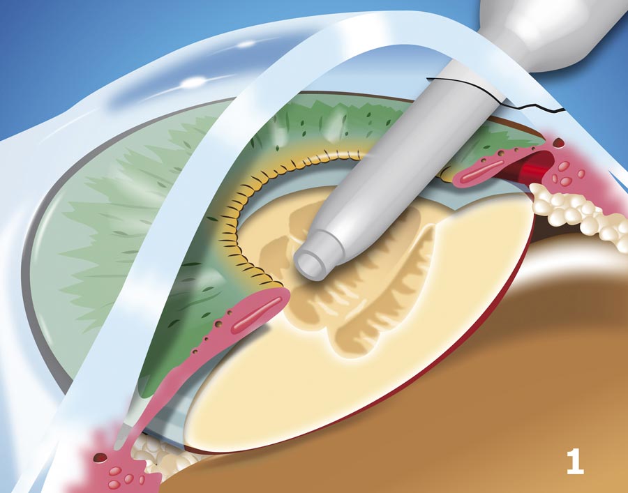 Small Incision Lens Removal with Ultrasonic